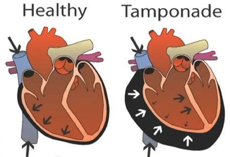 tamponade removal